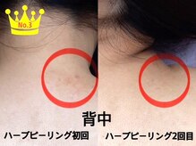 シェリー(Cheri)/背中ハーブビフォーアフター