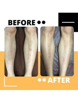 アルジェンヌ 五井店/メンズ脱毛 before/after