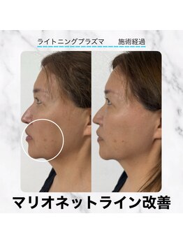 エクラ 六本木(eclat)/プラズマフェイシャル