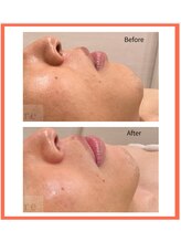 アールイー(re)/ララピール