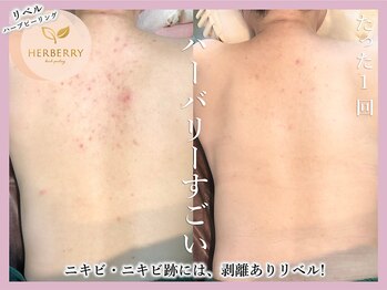 アッシュ 梅田(H)/ハーブピーリング専門Hアッシュ