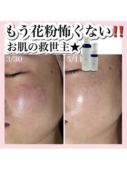 アルムダアクア 天王寺店(Aleumda AQUA)/ハーブピーリング/大阪/天王寺