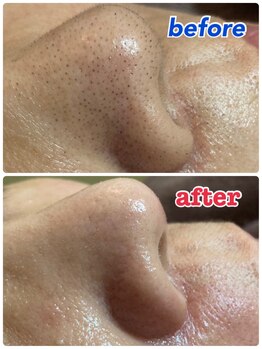 エステサロン桜/お顔ワックス脱毛