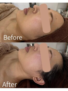 シーズ ザ デイ 熊本店(Seize the day)/毛穴オフ♪ララピール