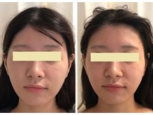 ナチュレアンドメディカ(Nature&Medica)/【たるみo 小顔】ソフウェーブLT