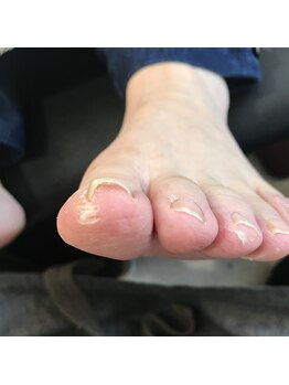 ネイルサロンアンドネイルスクール グレース(Nail salon & Nail school Grace)/トラブル爪