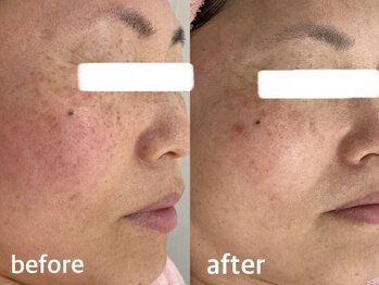 サクラ 伊勢原店(SAKURA)/大きなシミもシミケアで薄く