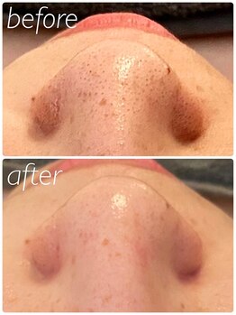 シス(SiS)/ハイドラ/毛穴黒ずみケア