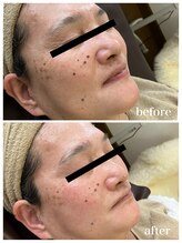 ジャスミン(Jasmin)/臍帯血幹細胞×NMN×AC-11