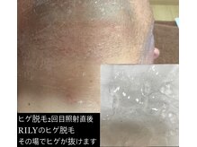 リリー(RILY)の雰囲気（1番人気のヒゲ脱毛♪髭剃り不要に最短で導きます！！）