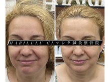 ハリルル 併設 GLケンタ鍼灸整骨院(HARILULU)/4回での変化　ハイパー×美容鍼