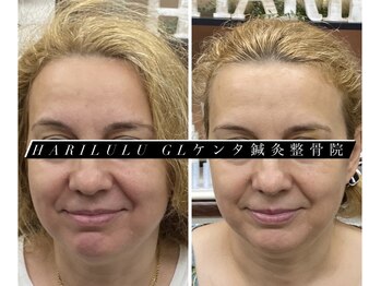 ハリルル 併設 GLケンタ鍼灸整骨院(HARILULU)/4回での変化　ハイパー×美容鍼