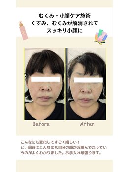 マインドール/泉大津小顔/むくみ・小顔ケア