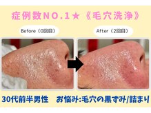 ウル 下北沢(Ulu)/韓国式3D毛穴洗浄