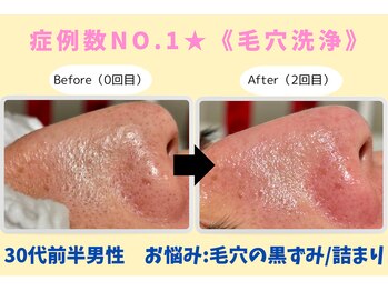 ウル 下北沢(Ulu)/韓国式3D毛穴洗浄