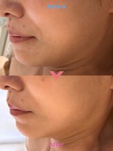 リュウ鍼灸院 サロン ド リュウ(Salon de Ryu)/表情筋をしっかり動かした結果