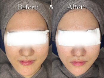 アイシス(AIsis)/黄くすみ改善【LDM1回】