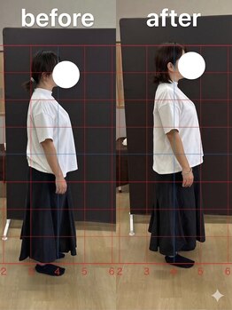 カワル整体 長嶺院/ストレートネック