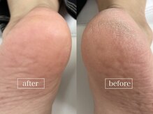 サーティースリー 塚口店(Thirty three)/大人気☆角質ケア