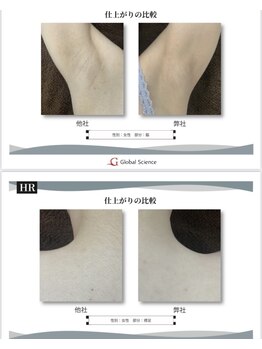 サンバイエム(#3/M)/全身脱毛