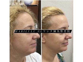 ハリルル 併設 GLケンタ鍼灸整骨院(HARILULU)/ハイパーナイフ×美容鍼