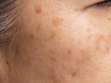 アンドアンド(&and)/濃い大きくてもシミケア◎