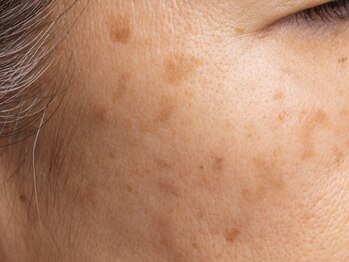 アンドアンド(&and)/濃い大きくてもシミケア◎