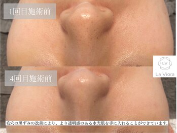 ラヴィオーラ 西大寺(La Viora)/ダイヤモンドハーブピーリング