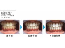 ルミナ(LUMINA)/コーヒー好きはホワイトニング！