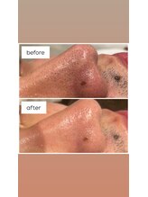 メンズナビ(men's nabi.)/ハイドラ毛穴洗浄before→after