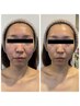 【毛穴・赤み・肌質改善】繰り返す肌悩みに｜再生美容フェイシャル