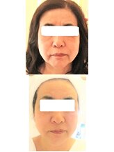 サロンドエステケイワイ(de KY)/フェイシャル☆小顔・タルミ改善