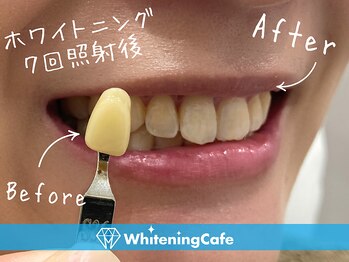 ホワイトニングカフェ 志木店/ホワイトニングビフォーアフター