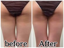 イデアルボーテ/脂肪冷却 下半身ビフォアフ