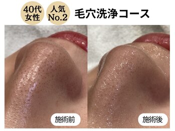 ディレイア ザ コスメ 有楽町マルイ店(direia the cosme)/毛穴黒ずみ/角栓［有楽町］