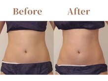 フィオーレ 麻布十番(Fiore)/肋骨が締まりくびれが出現する！