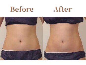 フィオーレ 麻布十番(Fiore)/肋骨が締まりくびれが出現する!