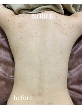 ノーブル 新宿南口(NOBLE)/背中リベルハーブピーリング