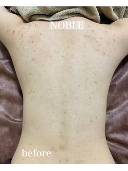 ノーブル 新宿南口(NOBLE)/背中リベルハーブピーリング