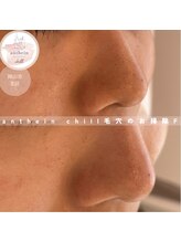 アンテイン チル(anthein chill)/毛穴のお掃除フェイシャル