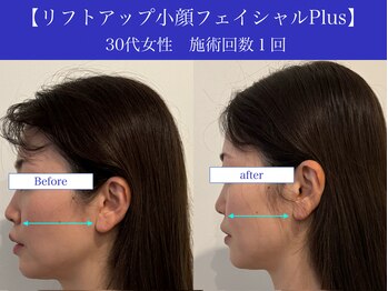 リプロ(RePro)/30代 ビフォーアフター