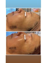 シャンディ(Shandy)/ラミピールでハリツヤUP