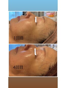 シャンディ(Shandy)/ラミピールでハリツヤUP