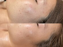 ビジュープラス 広島店(Bijou+)/【20代/ニキビケア】