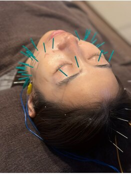 すぎ/たるみを改善してリフトアップ