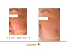 アムレット(Amourette)/肌管理はお任せください★