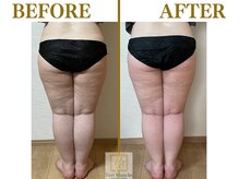 ヴェールブランシュ 町田(Vert Blanche)/#ブライダルエステ#痩身#太もも