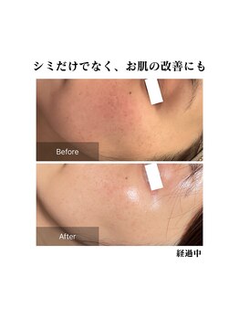 エムドット プラス(M DOT +)/シミケア×最新光フェイシャル