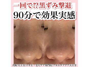 アルムダアクア 天王寺店(Aleumda AQUA)/毛穴エクストラクションプロ