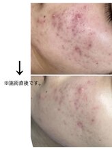 ヴィノ アイサロン(VINNO eyesalon)/ハーブピーリングでニキビ改善☆